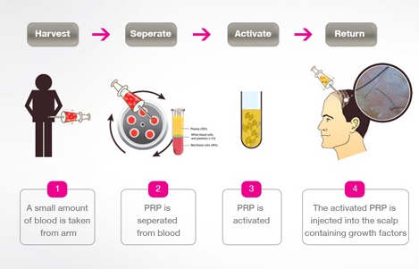 PRP-Procedure