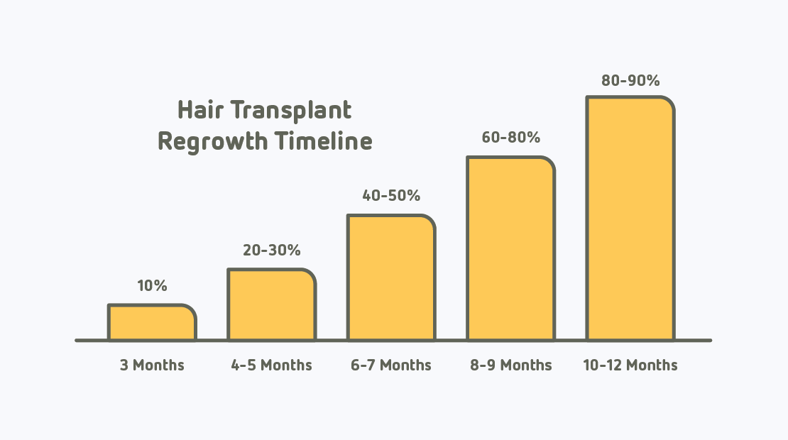 Hair Transplant Timeline - Everything You Need to Know - Aventus Clinic