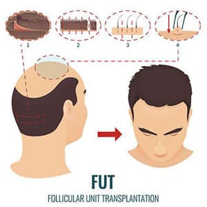 FUT Hair Transplant