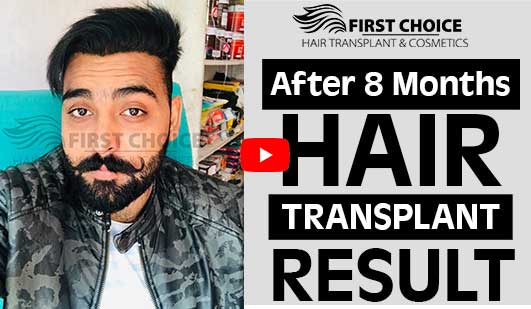 Hair Transplant in Amritsar - Best Doctors, Clinics & Cost | FCHTC