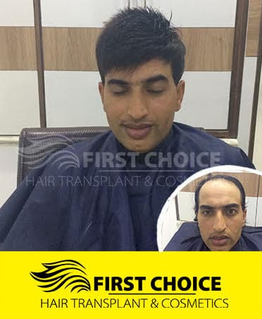 Hair Transplant Result of 2500 Grafts