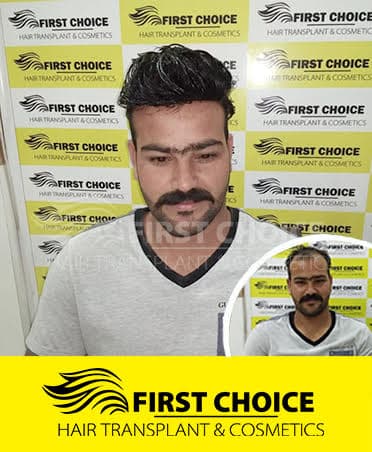 Hair Transplant Result of 4500 Grafts