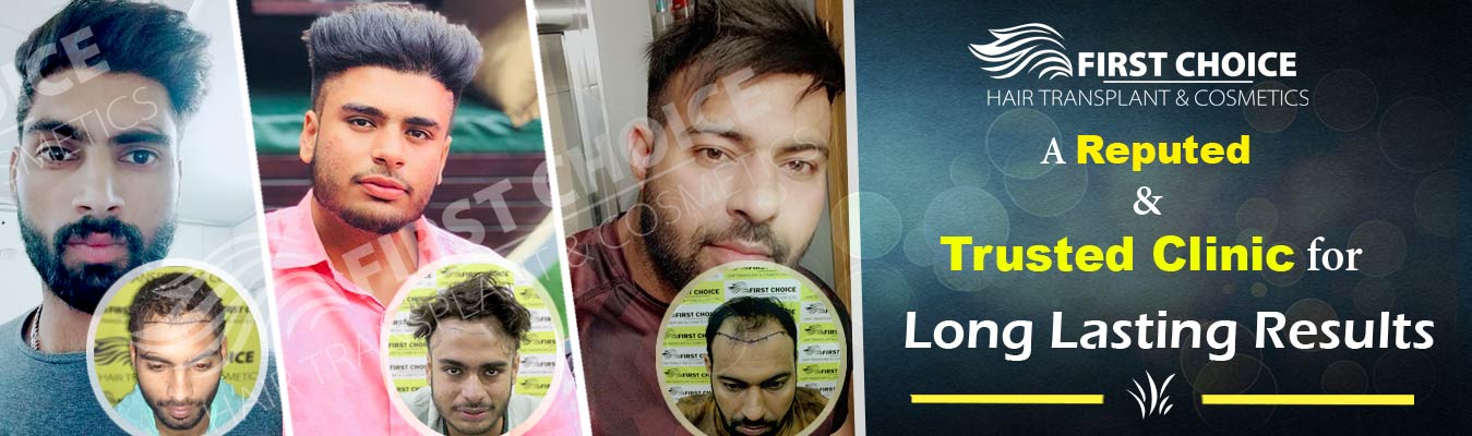 Hair Transplant results