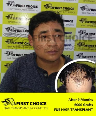 Hair Transplant Result of 6000 Grafts