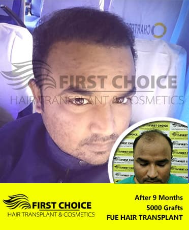 Hair Transplant Result of 5000 Grafts