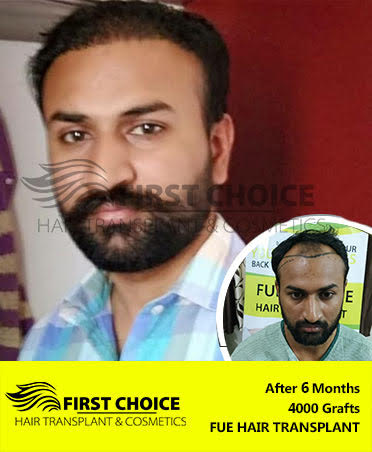 Hair Transplant Result of 6000 Grafts