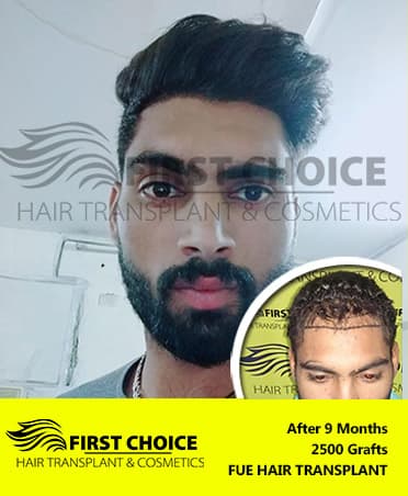 Hair Transplant Result of 2500 Grafts