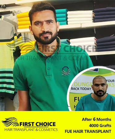 Hair Transplant Result of 6000 Grafts