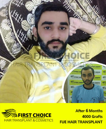 Hair Transplant Result of 6000 Grafts