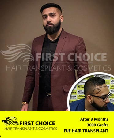 Hair Transplant Result of 3000 Grafts