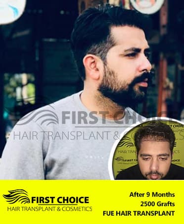 Hair Transplant Result of 2500 Grafts