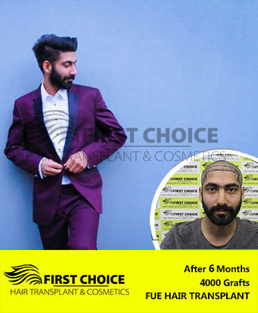 Hair Transplant Result of 6000 Grafts