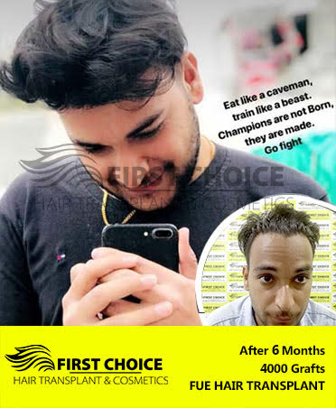 Hair Transplant Result of 6000 Grafts