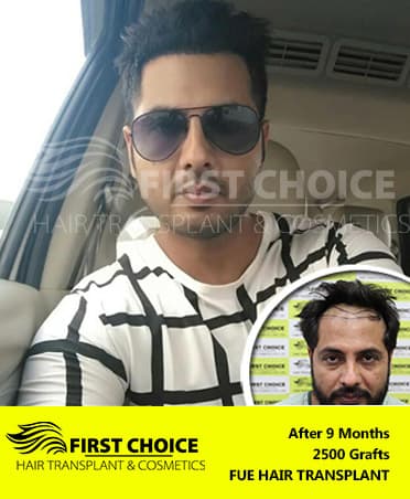 Hair Transplant Result of 2500 Grafts