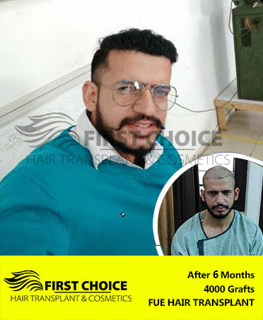 Hair Transplant Result of 6000 Grafts