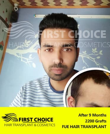 Hair Transplant Result of 2200 Grafts