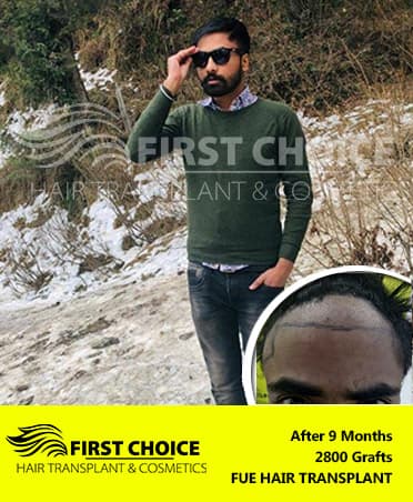 Hair Transplant Result of 2800 Grafts