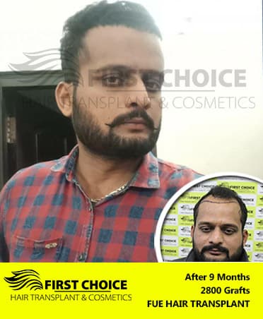 Hair Transplant Result of 2800 Grafts