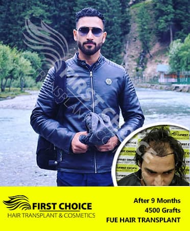 Hair Transplant Result of 4500 Grafts