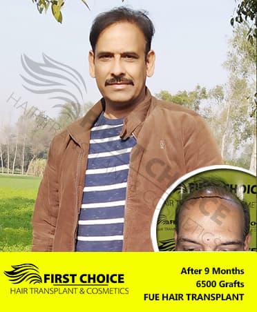 Hair Transplant Result of 6500 Grafts