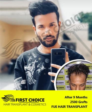 Hair Transplant Result of 2500 Grafts