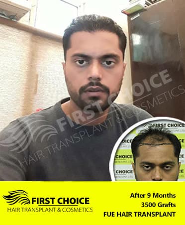 Hair Transplant Result of 3500 Grafts