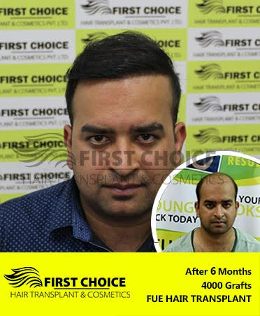 Hair Transplant Result of 6000 Grafts