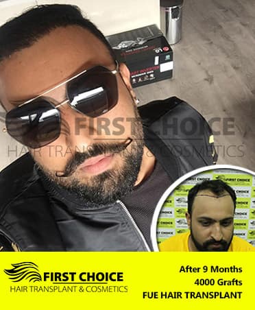 Hair Transplant Result of 4000 Grafts