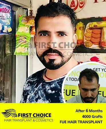 Hair Transplant Result of 6000 Grafts