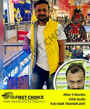 Hair Transplant Result of 4300 Grafts