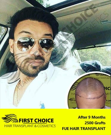 Hair Transplant Result of 2500 Grafts