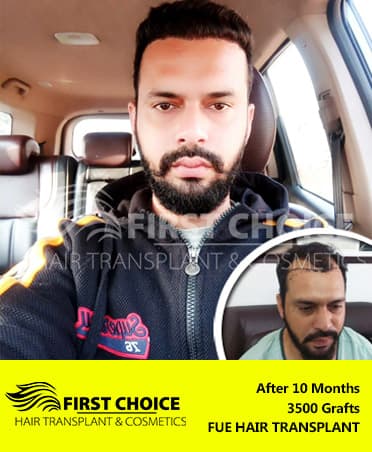 Hair Transplant Result of 3500 Grafts