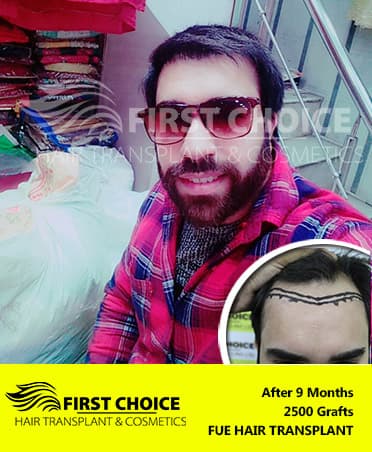 Hair Transplant Result of 2500 Grafts