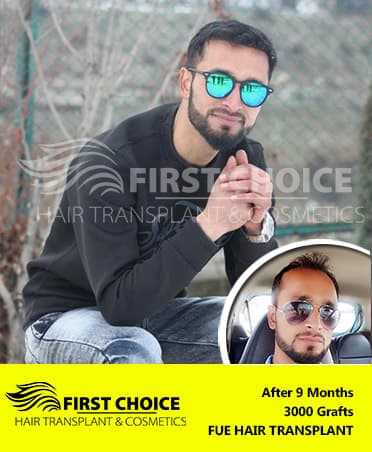 Hair Transplant Result of 3000 Grafts