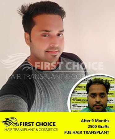 Hair Transplant Result of 2500 Grafts