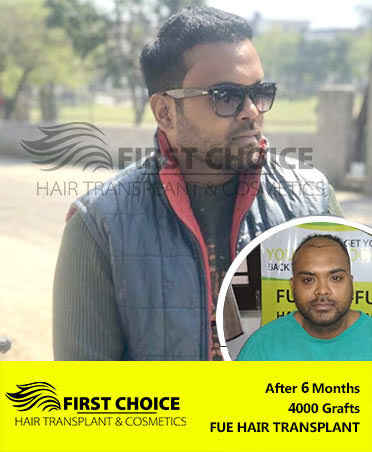 Hair Transplant Result of 6000 Grafts