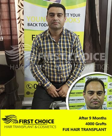 Hair Transplant Result of 4000 Grafts