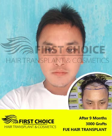 Hair Transplant Result of 3000 Grafts