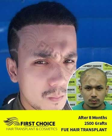 Hair Transplant Result of 2500 Grafts