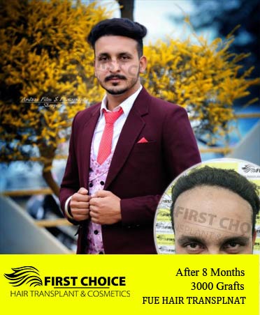 Hair Transplant Result of 3000 Grafts