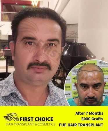Hair Transplant Result of 5000 Grafts