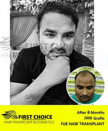 Hair Transplant Result of 2500 Grafts