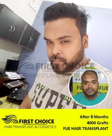 Hair Transplant Result of 4000 Grafts