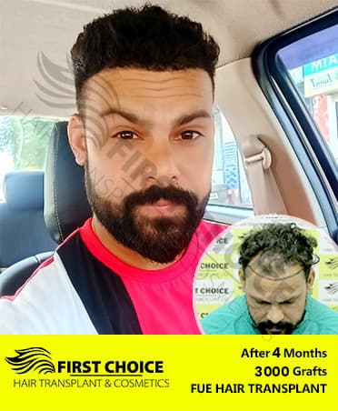 Hair Transplant Result of 3000 Grafts