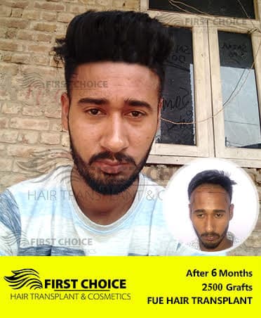 Hair Transplant Result of 2500 Grafts