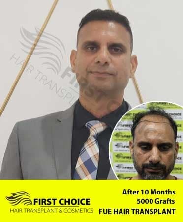 Hair Transplant Result of 5000 Grafts