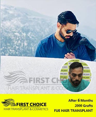 Hair Transplant Result of 2000 Grafts