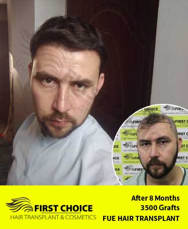 Hair Transplant Result of 3500 Grafts