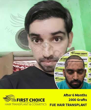 Hair Transplant Result of 2000 Grafts