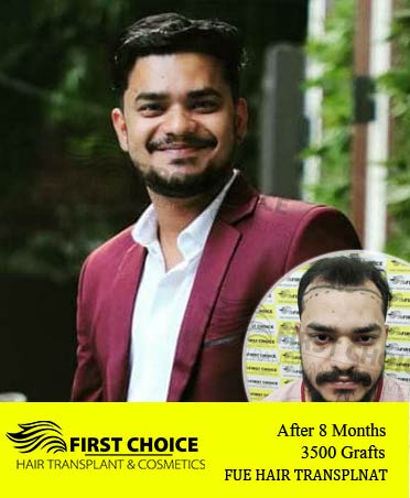 Hair Transplant Result of 3500 Grafts